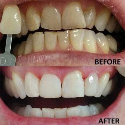 teeth-whitening-before-after-032