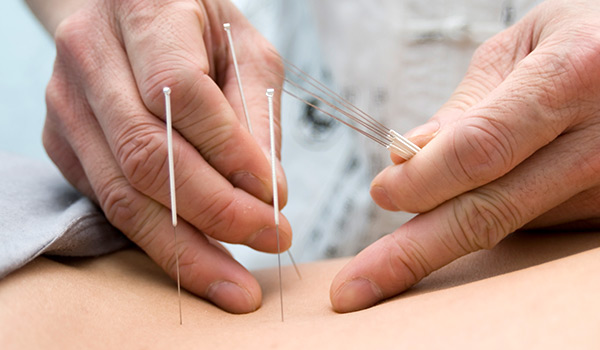 Doctor applying acupuncture needles