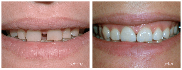 Ortho before and after smile