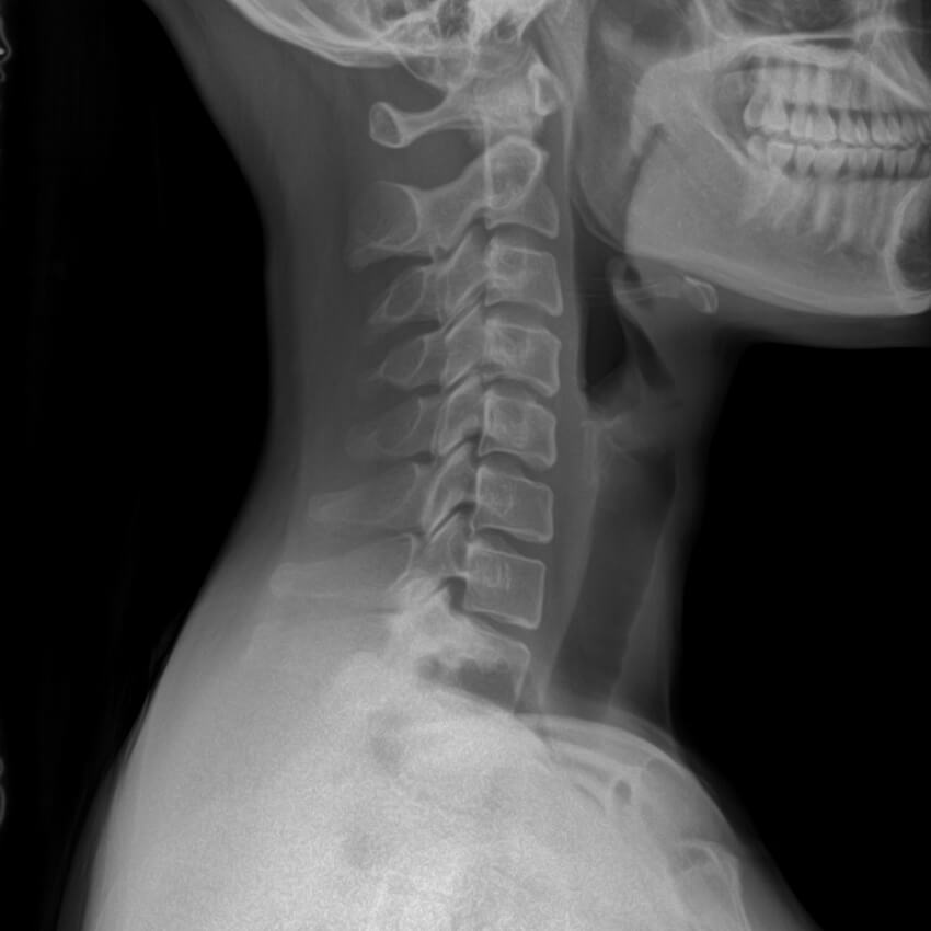 xray of persons neck from the side