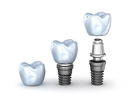 Dental implant illustration