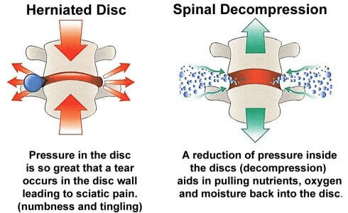 Spinal Decompression Diagram