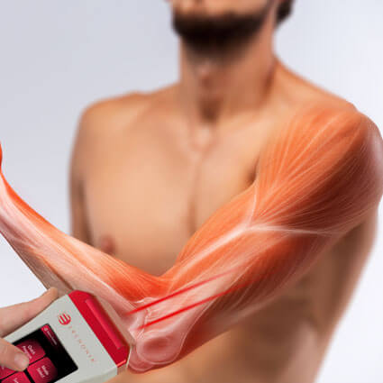 Laser therapy illustration on arm