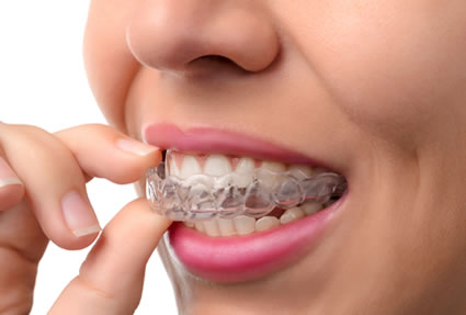 Woman wearing clear aligner