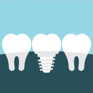 Dental implants