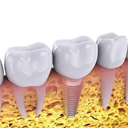 ultimate-guide-to-dental-implants-in-caringbah