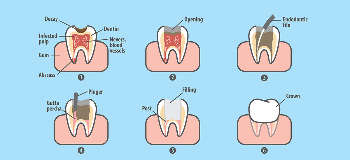 root canal illustration