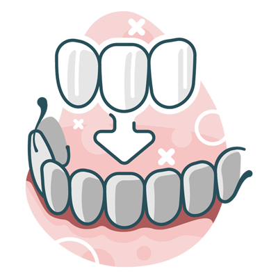 dental veneers illustration