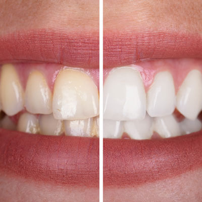 teeth whitening comparison on teeth