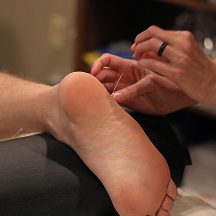 Applying acupuncture needles