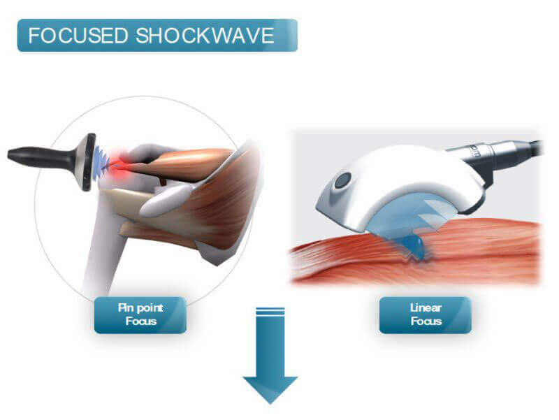 Focused Shockwave Diagram