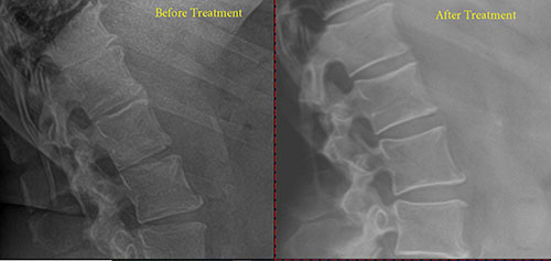Before and after xrays