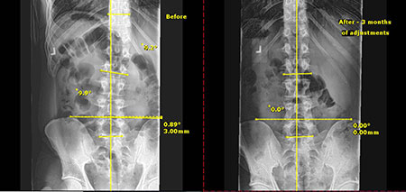 Spine comparison