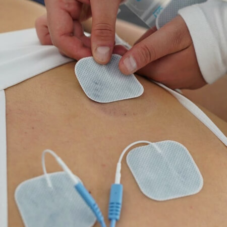 Patient treated with E-Stim Therapy