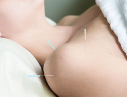 shoulder closeup with acupuncture needles