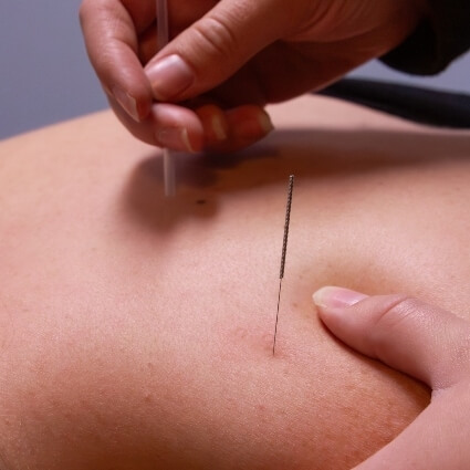 Acupuncture needles in persons skin