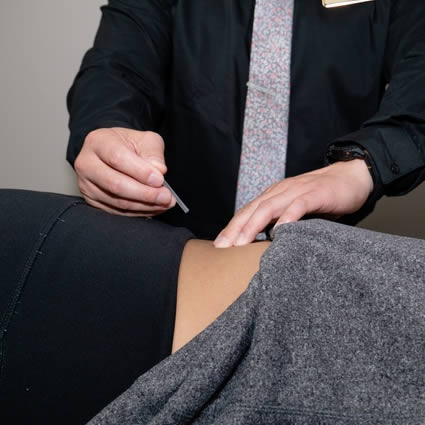 Dry Needling therapy