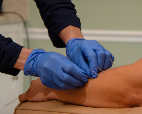 Applying needles to arm