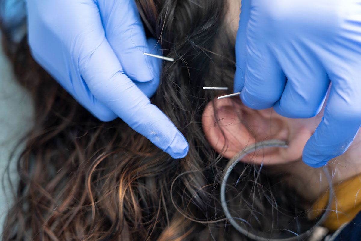 Applying needles by ear