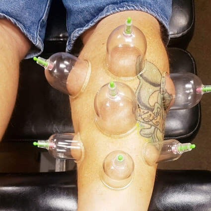 Cupping on patients leg