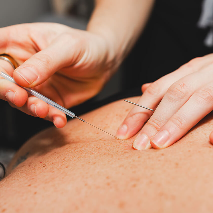 practitioner placing acupuncture needles in patients back