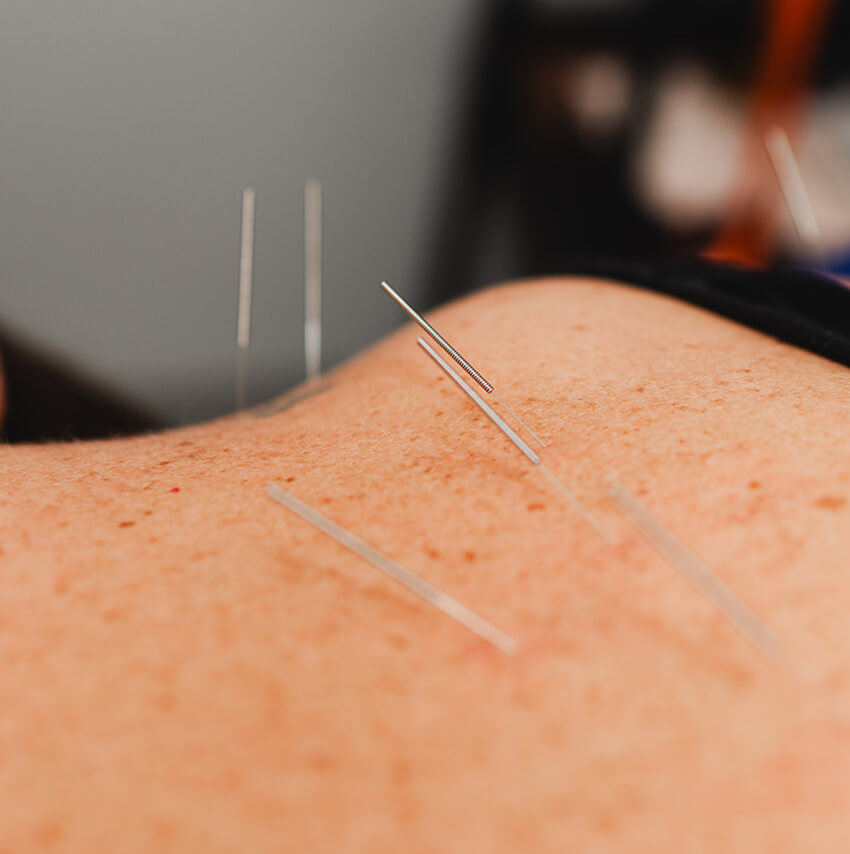 acupuncture needles in persons skin