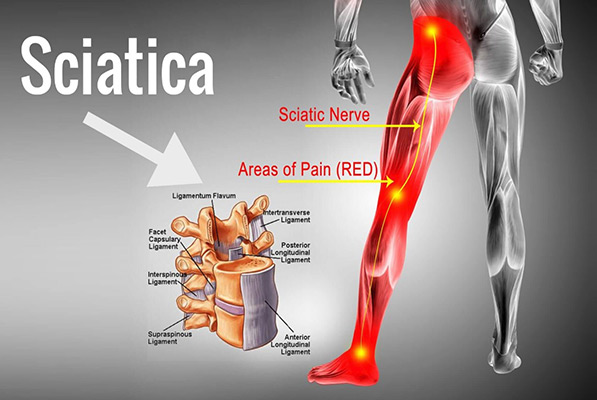Muscular model showing the sciatic nerve