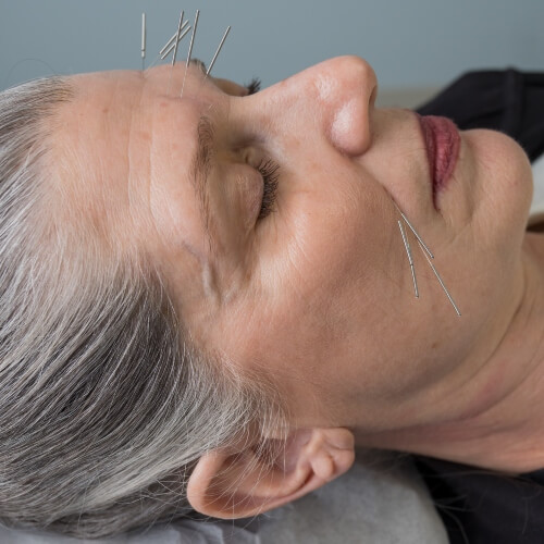 Female patient treated with Acupuncture