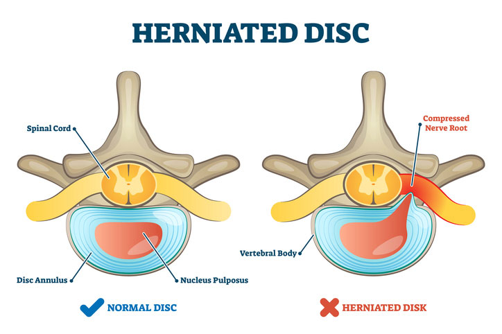Hernitated disc model