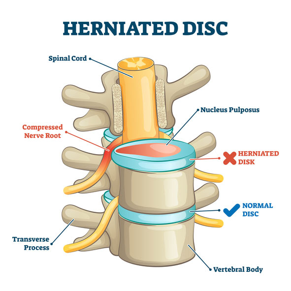 Spinal decompression illustration