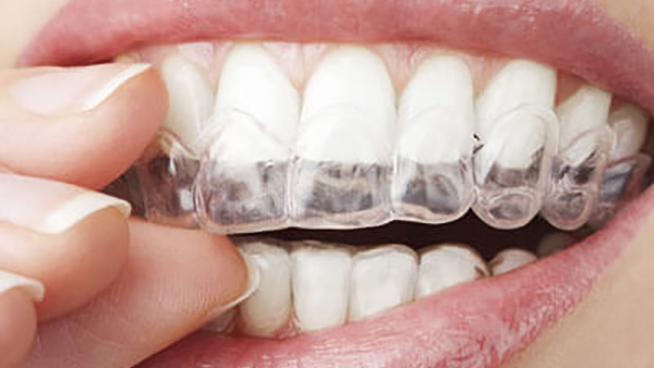 person putting in clear aligner