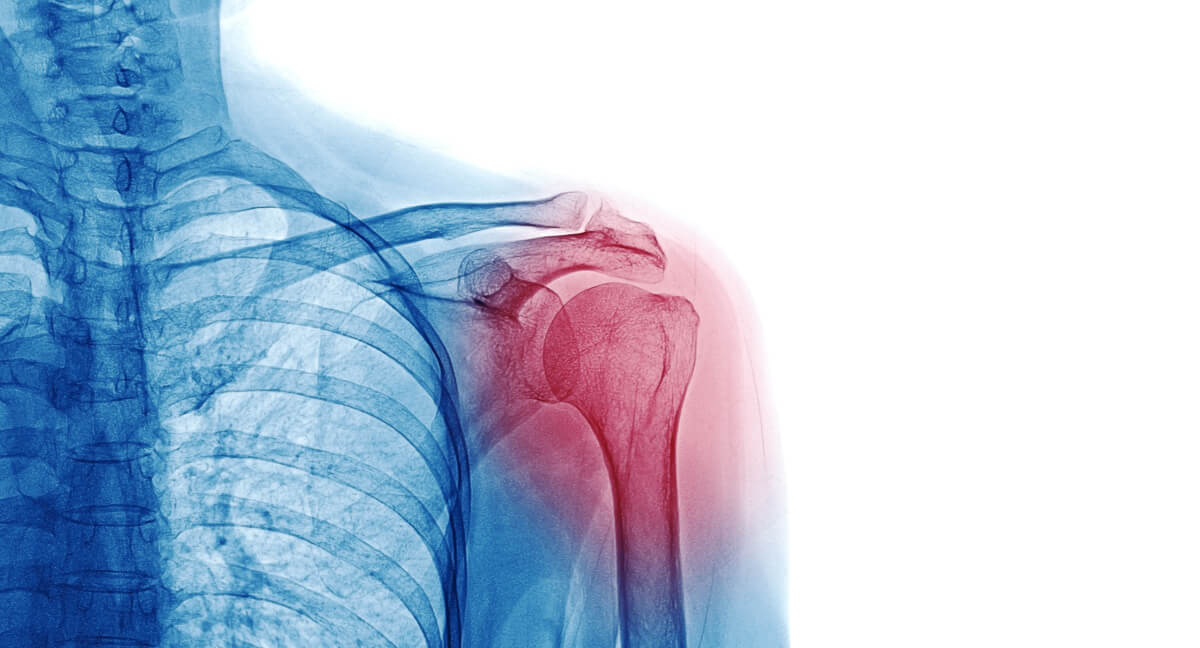 Shoulder pain illustration