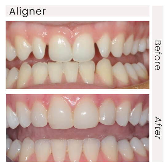 Aligner