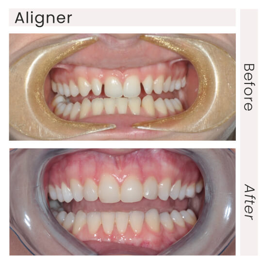 aligner before and after