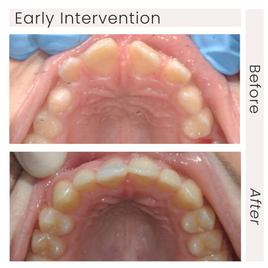early intervention before and after