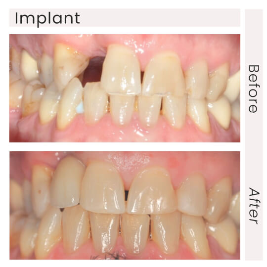 Implant before and after