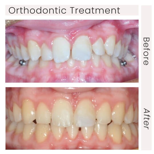 ortho treatment before and after