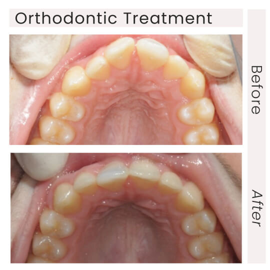 ortho before and after