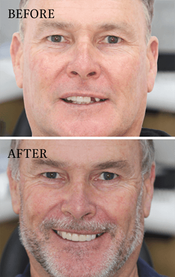 before and after smile