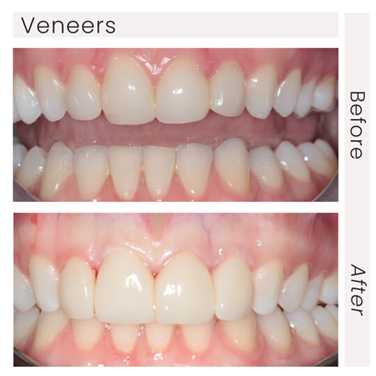 Veneers