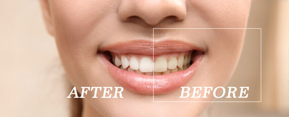 whitening before and after