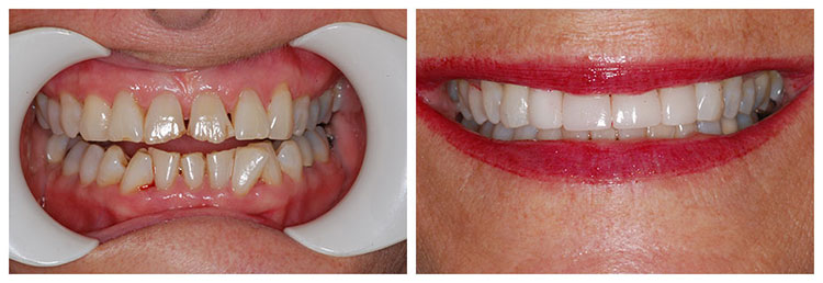 Veneers, bleaching and ortho before and after