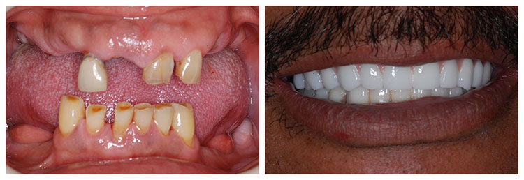 All on 4 before and after
