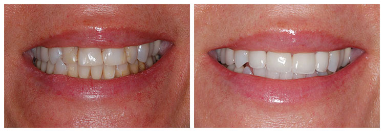 Veneers before and after