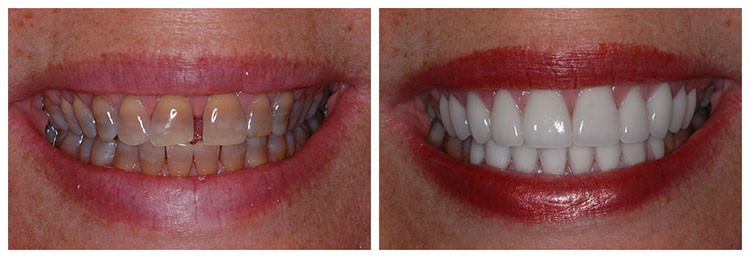 Stained teeth before and after