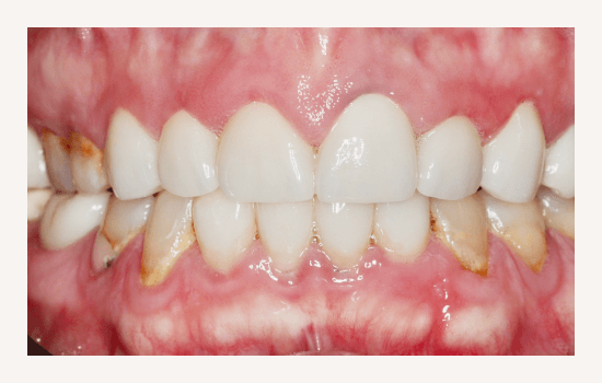 Anterior Crowns