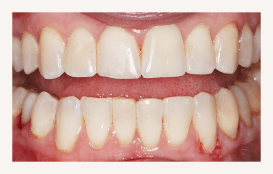 Invisalign Treatment Crowding