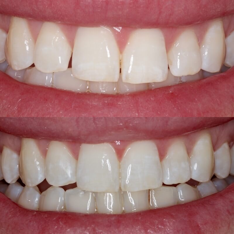 invisalign crowding before and after