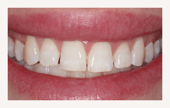 Invisalign Treatment