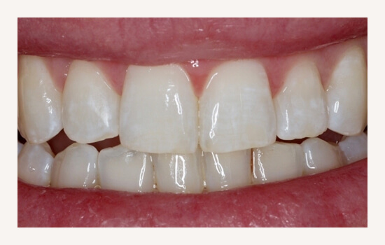 Invisalign Treatment